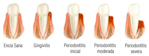 gingivitis periodontitis