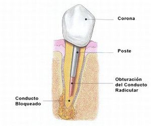 endodoncia con poste corona en tenerife