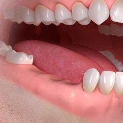 implantes dentales perdida varios dientes