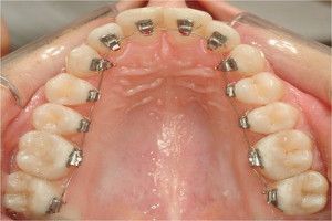 tratamiento-ortodoncia-lingual-en-tenerife
