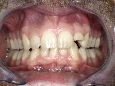 reconstrucción de un diente fracturado
