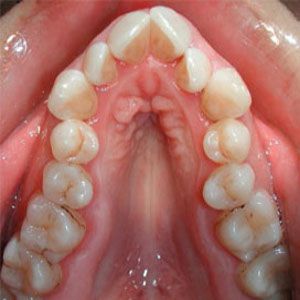 manias perjudiciales que afectan a los dientes compresion maxilar