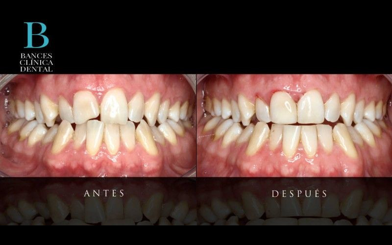 Tratamientos de Estética Dental Indoloros