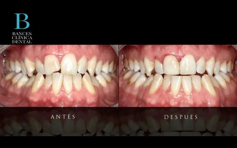 Tratamientos de estética dental indoloras