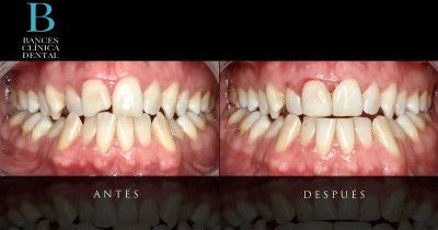 tratamientos de estetica dental indoloros