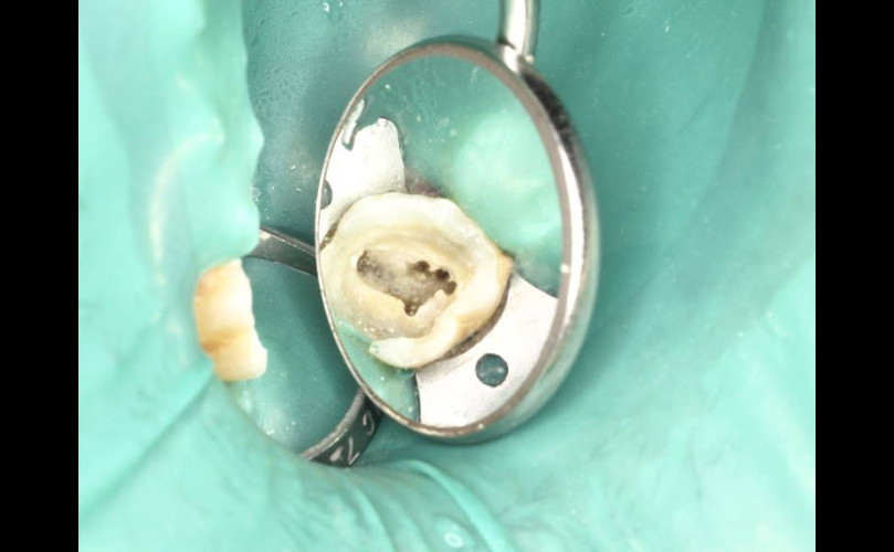 Tipos de endodoncias