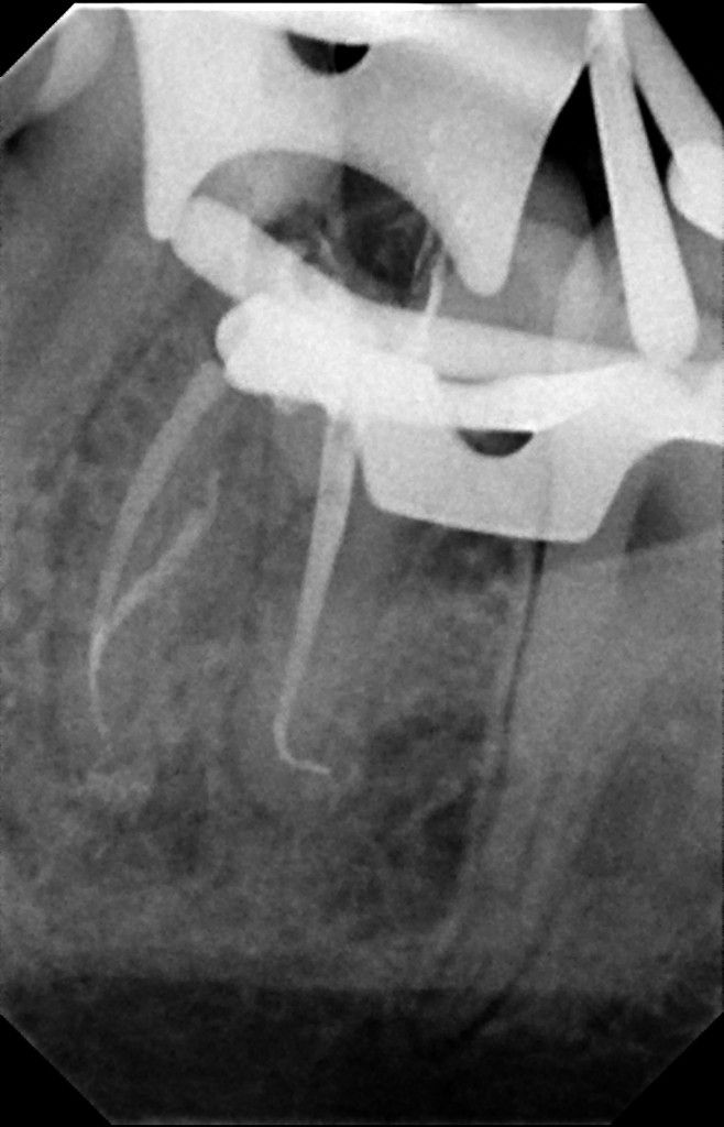 proceso de una endodoncia