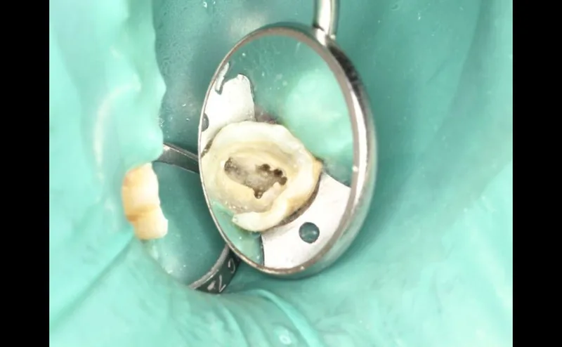 Tipos de endodoncias