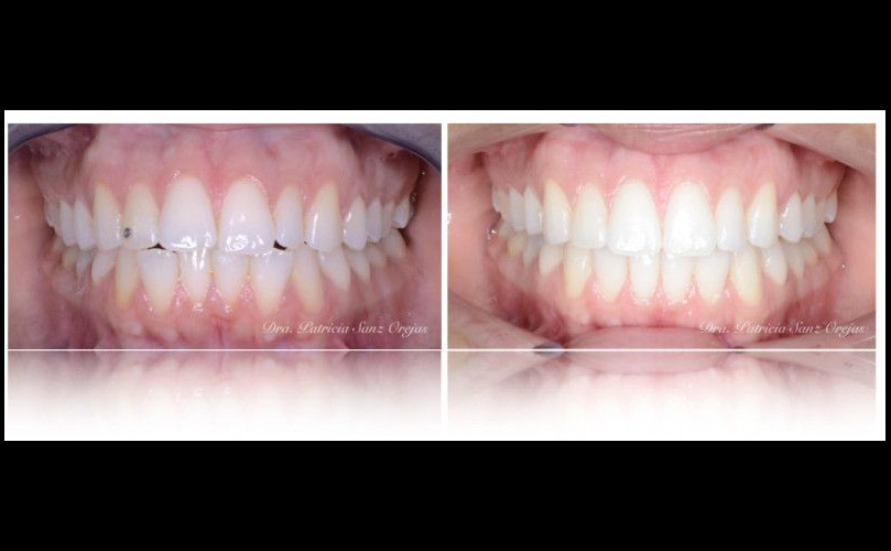 Caso Clínico Ortodoncia con Invisalign