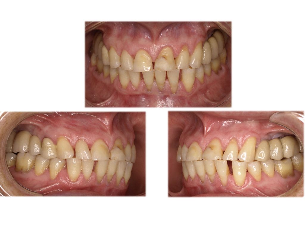 Carillas dentales: ¿Qué pueden hacer por mi sonrisa?