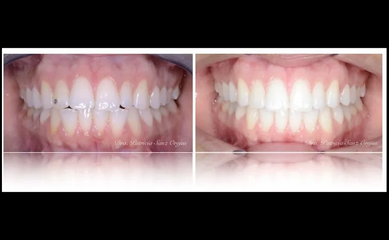 Caso Clínico Ortodoncia con Invisalign
