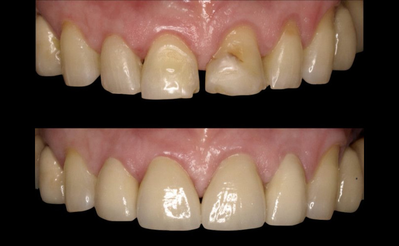 Carillas de Alta Estética. Diseño de la Sonrisa