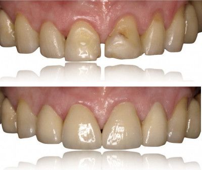 Carillas dentales - Antes y Después