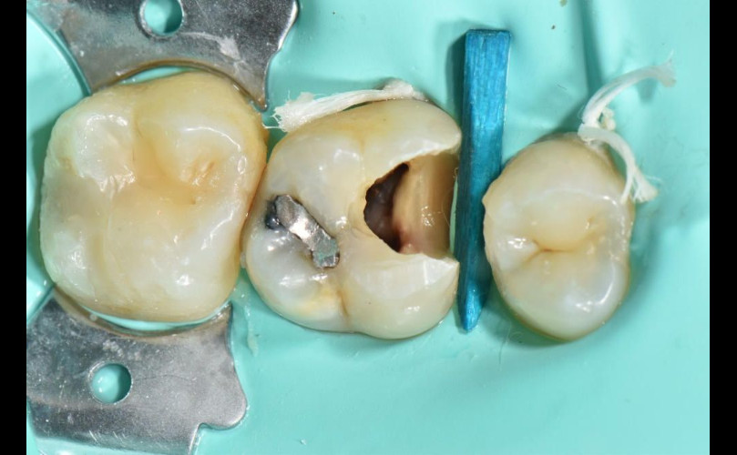 De la Endodoncia a la Reconstrucción