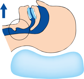 Tratamiento para apnea del sueño en adultos