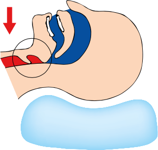 Tratamiento para apnea del sueño en niños