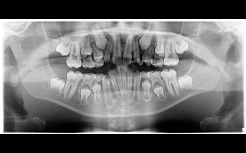 Radiografías dentales en niños