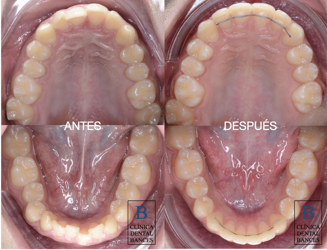 resistencia Definir eco Tratamiento de Ortodoncia