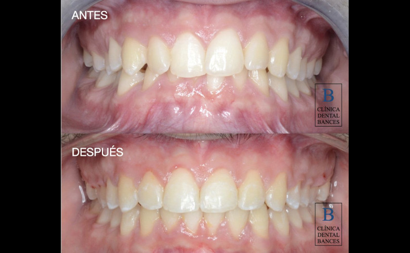 Tratamiento de Ortodoncia