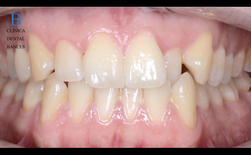 ORTODONCIA INVISALIGN