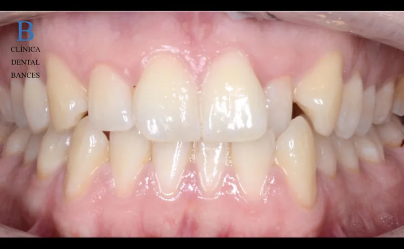 ORTODONCIA INVISALIGN