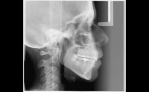 La importancia del perfil en el tratamiento de ortodoncia