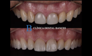 Tratamiento Ortodoncia, Blanqueamiento y Carillas