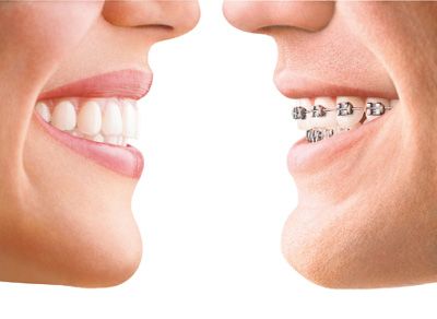 Tratamiento con Invisalign