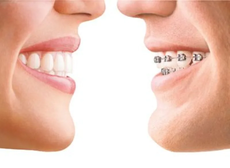 Tratamiento con Invisalign