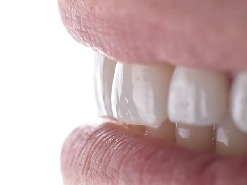 Blanqueamiento Dental Profesional en Santa Cruz de Tenerife​