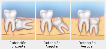 colocación muelas del juicio