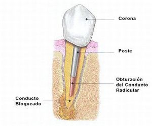 endodoncia con poste corona