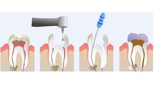 endodoncia