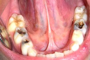 odontopediatría empastes diente de leche