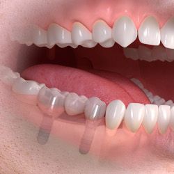 implantes dentales perdida varios dientes