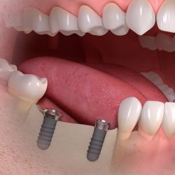 implantes dentales perdida varios dientes