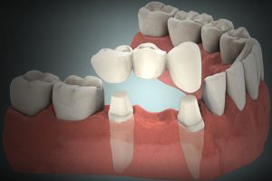 puente protésico dental en Tenerife
