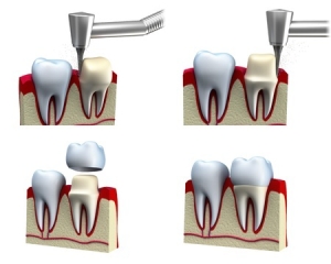 tallado de corona dental en Tenerife