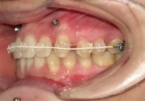 Microtornillos en ortodoncia en Santa Cruz de Tenerife