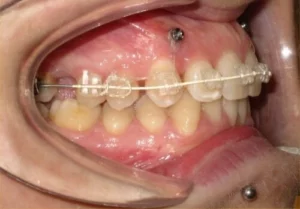 Microtornillos en ortodoncia en Santa Cruz de Tenerife