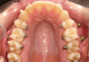 Microtornillos en ortodoncia en Santa Cruz de Tenerife