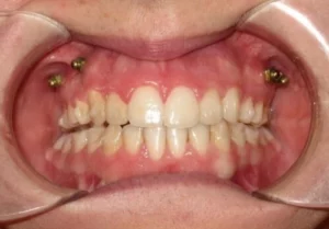 Microtornillos en ortodoncia en Santa Cruz de Tenerife