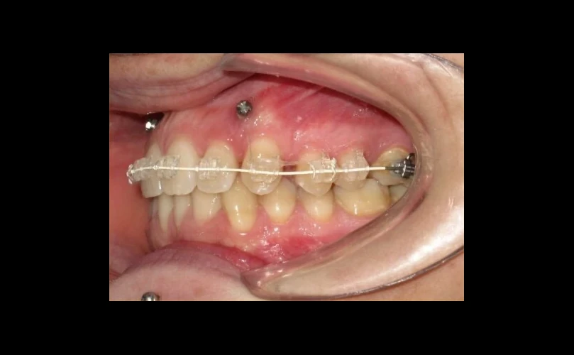 Microtornillos en ortodoncia en Santa Cruz de Tenerife