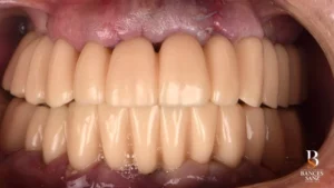 Resultado de carga inmediata con prótesis provisionales colocadas 24-48 horas tras la cirugía.