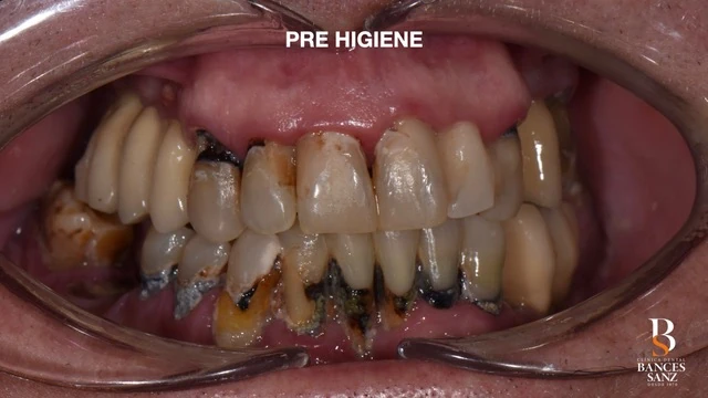 Boca de paciente con deterioro severo, caries múltiples y enfermedad periodontal antes del tratamiento.