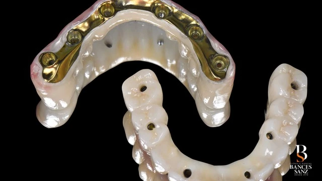 Prótesis definitiva mostrando la estructura interna de titanio para máxima resistencia.