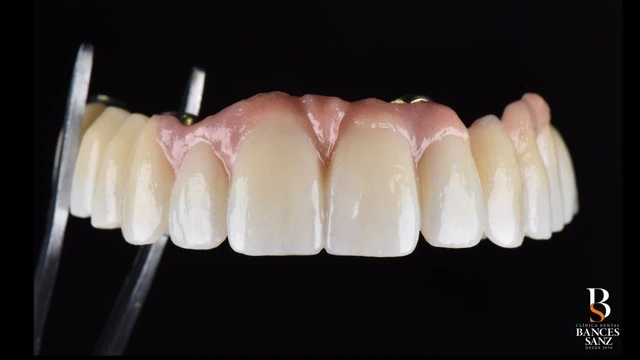 Trabajo de laboratorio dental de precisión para el diseño de encía y dientes con estética natural.