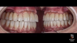 Vista lateral mostrando la oclusión y ajuste estético de las prótesis definitivas bimaxilares.