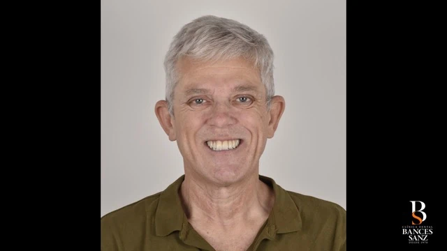 Paciente sonriendo tras recuperar la función y estética dental en clínica de Santa Cruz de Tenerife.