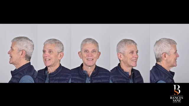 Planificación digital de sonrisa y análisis facial realizado con escáner intraoral iTero Lumina.